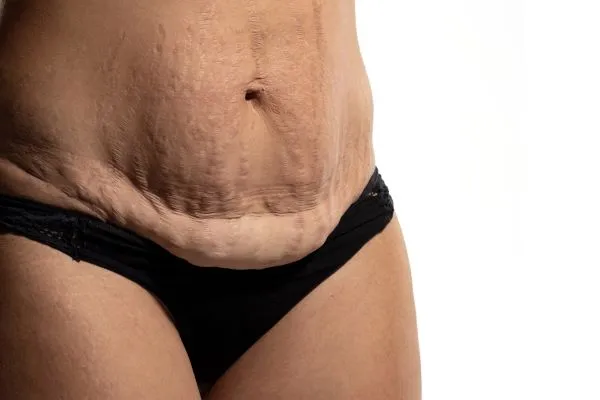 Lost the Weight but Not the Loose Skin? 1 image of womans stomach after weight loss showing loose skin Stratford